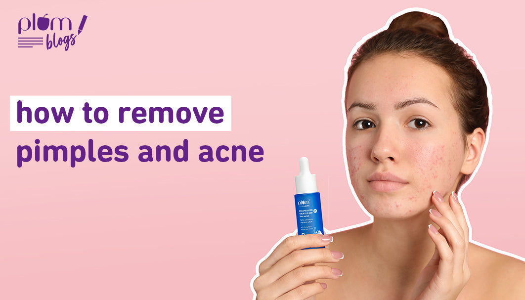 How to get rid of pimples and acne: Comparing natural and clinical treatments