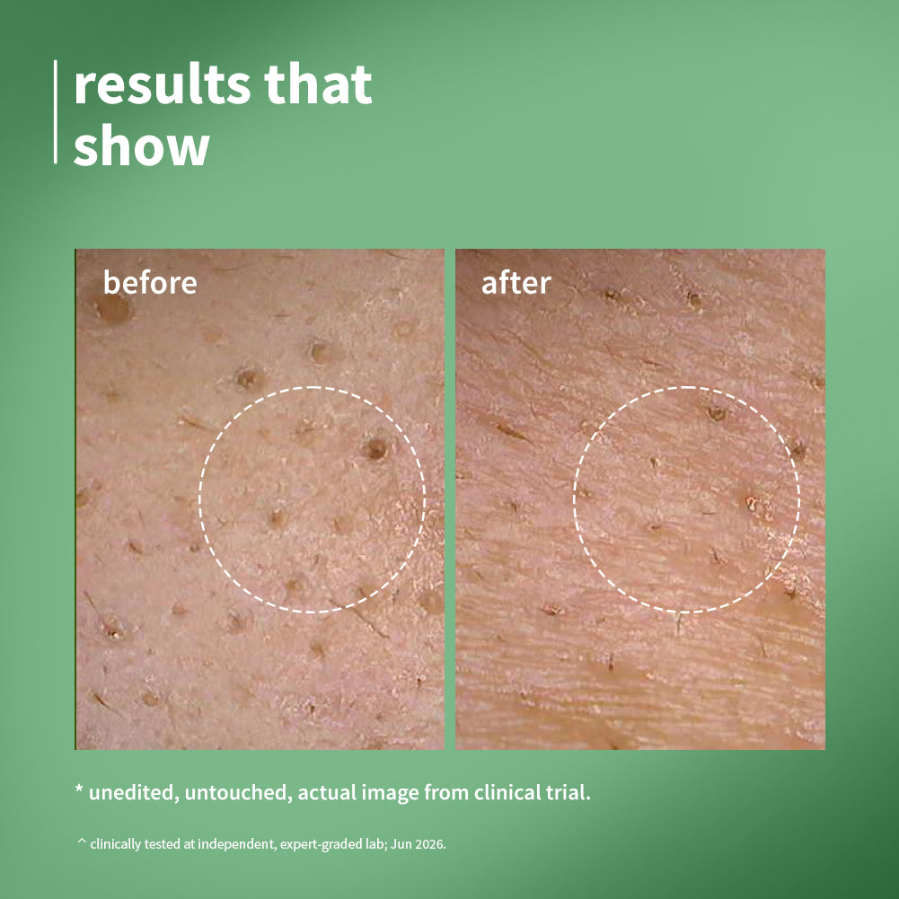 2% Encapsulated Salicylic Acid Face Serum For Acne-Prone Skin