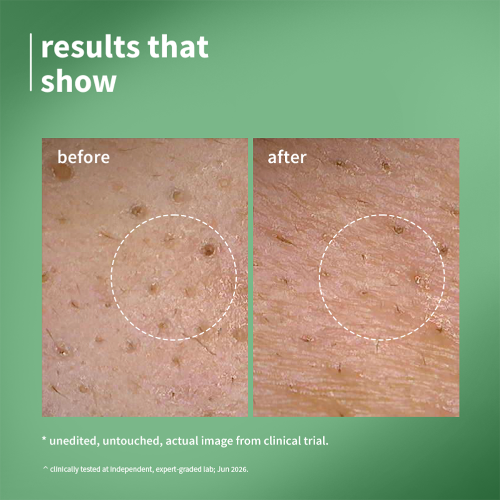 2% Encapsulated Salicylic Acid Face Serum For Acne-Prone Skin
