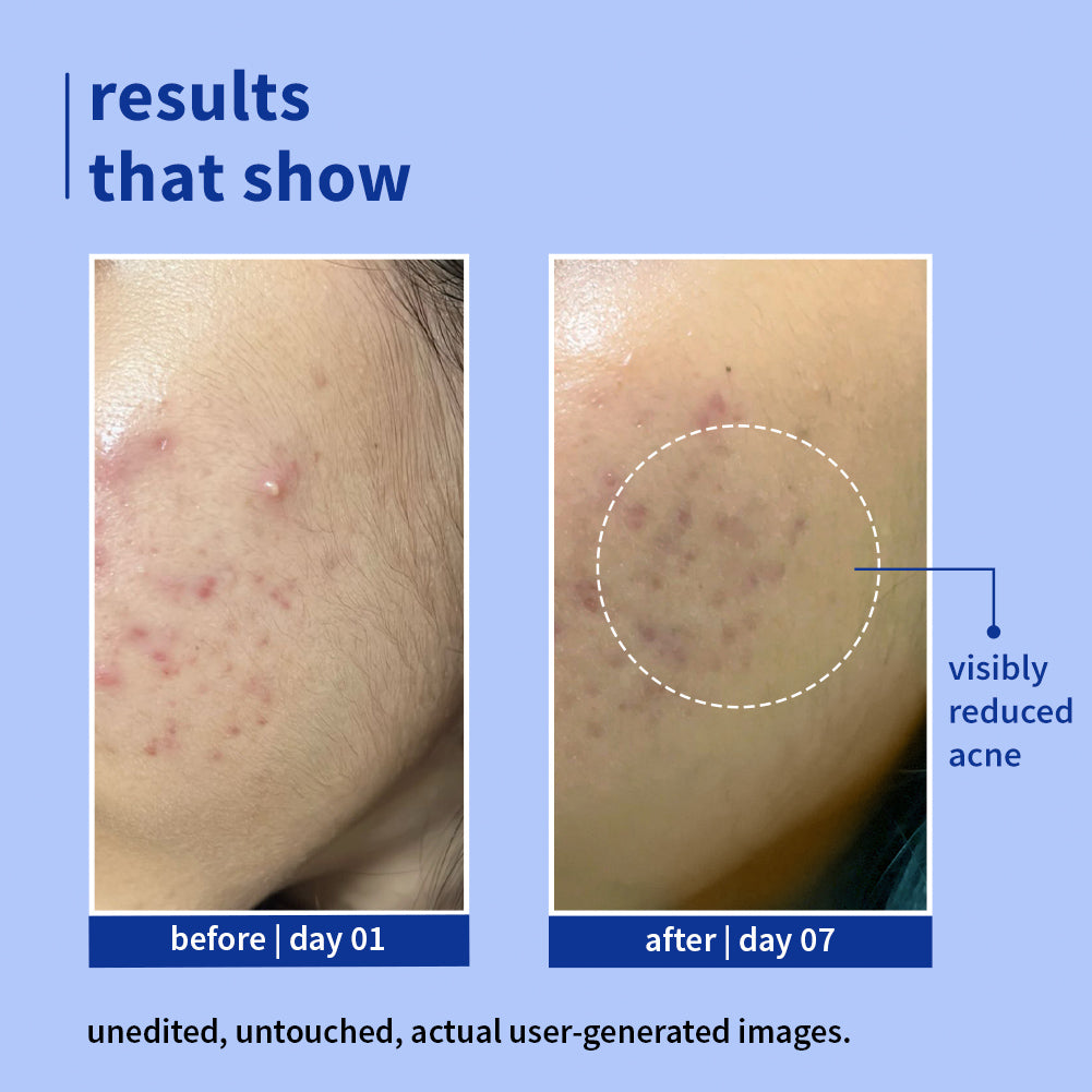 1% Salicylic Acid Clearly Gentle Gel Face Wash For Acne-Prone Skin